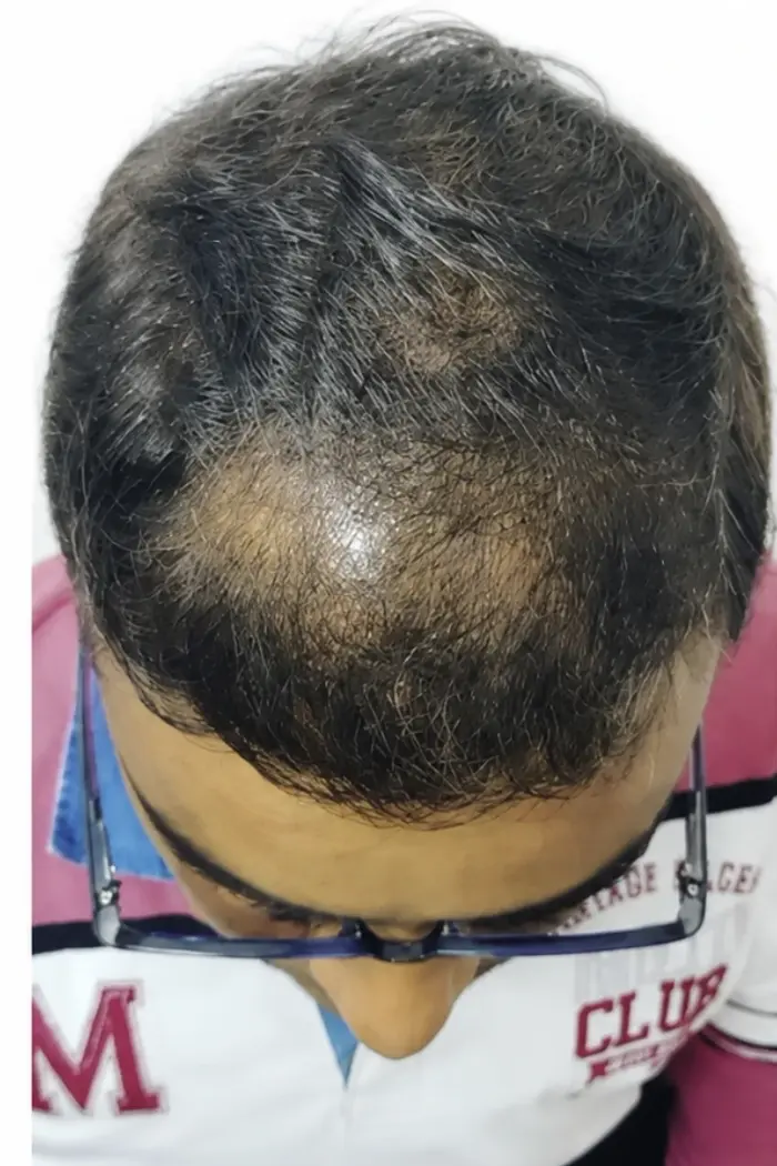 Male Pattern Baldness case 5 before treatment